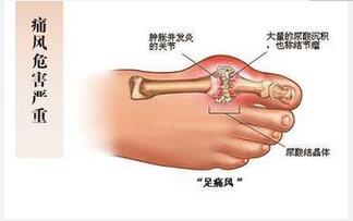 痛風病人吃什么好？ 飲食需合理搭配