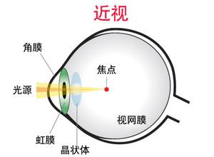 戴眼鏡會(huì)讓眼睛近視度數(shù)加深？